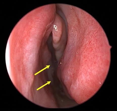 Endoscopic view of a normal nasal cavity for comparison. .
