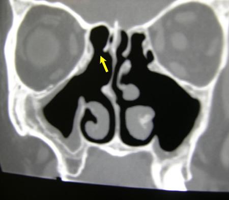 Figure 1c - CT scan of patient in Figure 1a following treatment with the piezosurgery device. The bone, scar tissue, mucus and infection have been removed and normal sinus drainage has been restored to the area. The black area on the CT scan that has replaced the previous gray area, indicates good sinus ventilation. The patient's eye discomfort and headaches improved greatly following surgery.