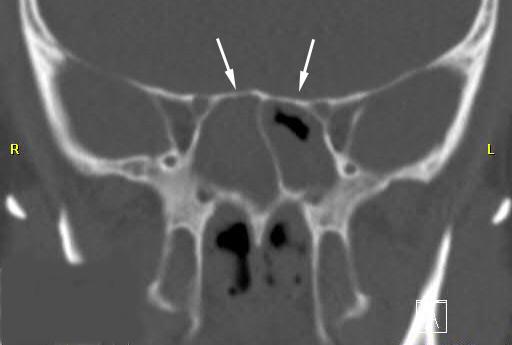 CT scan of sinus disease