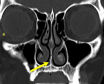 Figure 1a – CT scan of a patient with a normal straight nasal septum (arrow).