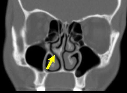Figure 1b – CT scan of a patient with a deviated nasal septum (arrow). The septum deviates into the nasal cavity restricting airflow, causing the patient to experience nasal congestion.