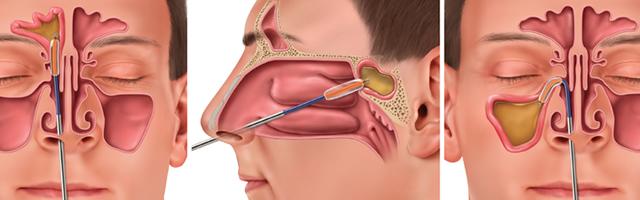 Balloon Sinuplasty