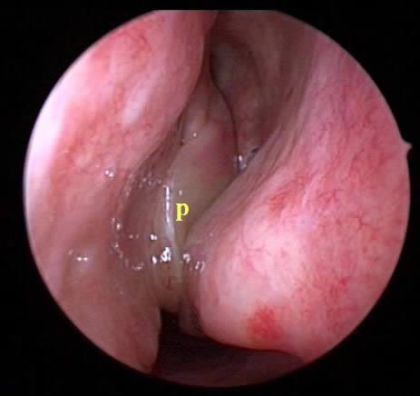 Figure 1a - View of the nasal cavity through a sinus endoscope. A large polyp is evident (p) filling the nasal cavity causing the patient symptoms of restricted nasal breathing.