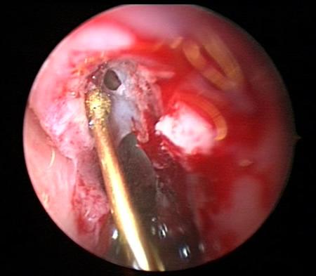 Figure 1b Endoscopic photo showing the piezosurgery device (gold) treating the thick bone. The device removes bone but preserves the important sinus membrane. The membrane can be seen above the piezosurgery device; it has been opened to drain the infection.