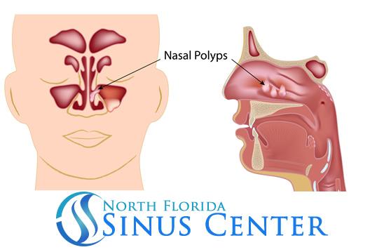 Nasal Polyps obstructioning the nasal pathway.