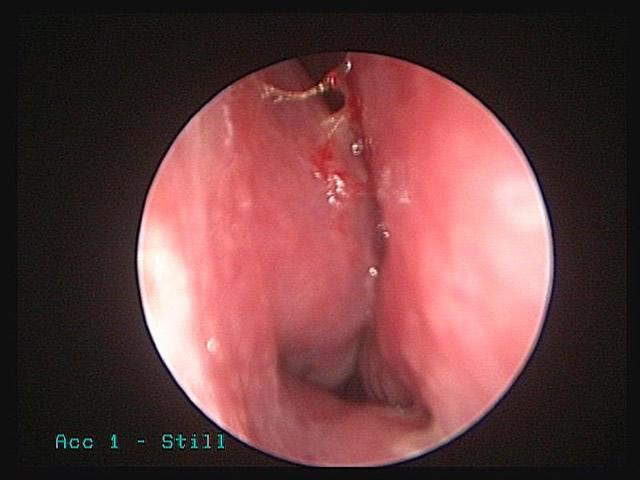 View of the right nasal cavity through a sinus endoscope of a patient with rhinitis and nasal obstruction.