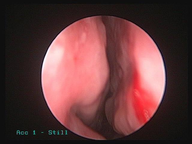 Following medical therapy, the swelling has decreased, the nasal airway has returned and the patient's nasal congestion symptoms resolved.