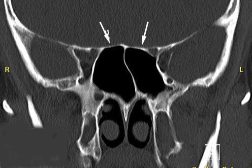 Ct scan after sinus treatment.